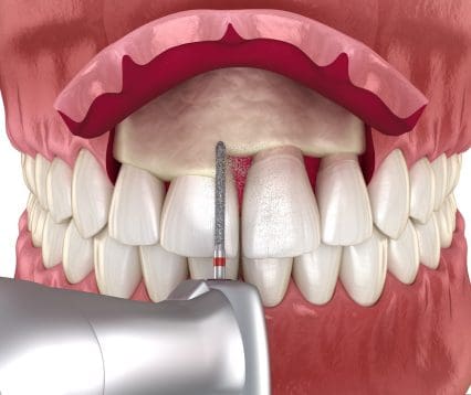 Frontal,Crown,Lengthening,,Esthetic,Surgery.,Medically,Accurate,Dental,3d,Illustration